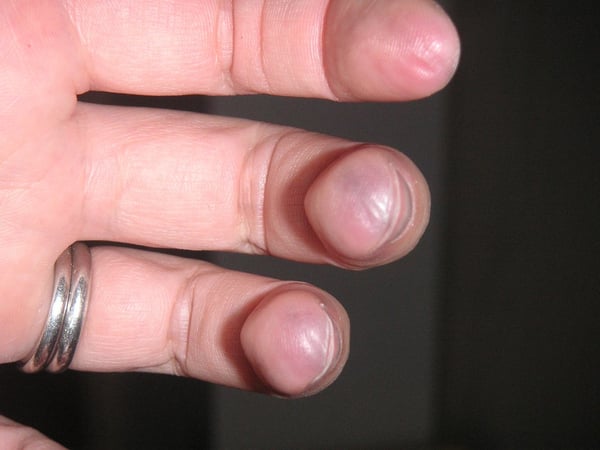 Calluses from playing the guitar